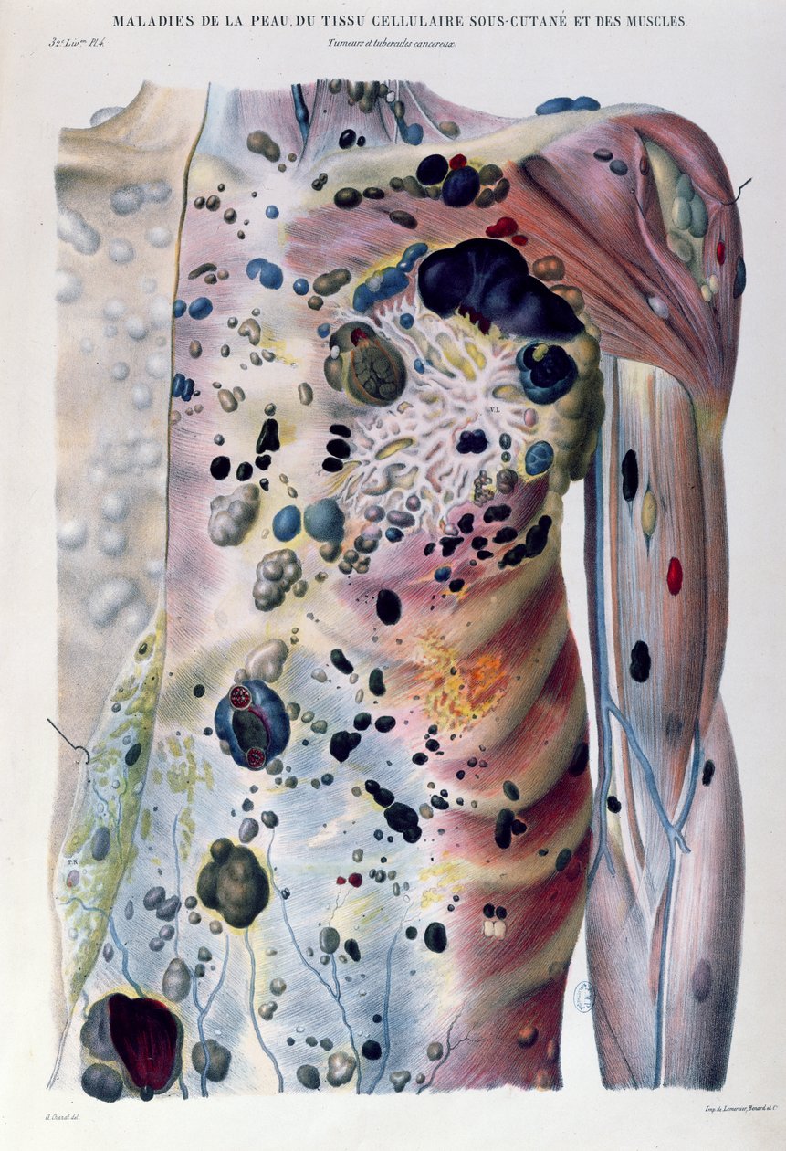 Kasvaimet ja syöpä tuberkuloosit, Jean Cruveilhierin (1791-1874) 1828-42 Anatomie Pathologique du Corps Humainista tekijältä Antoine Chazal