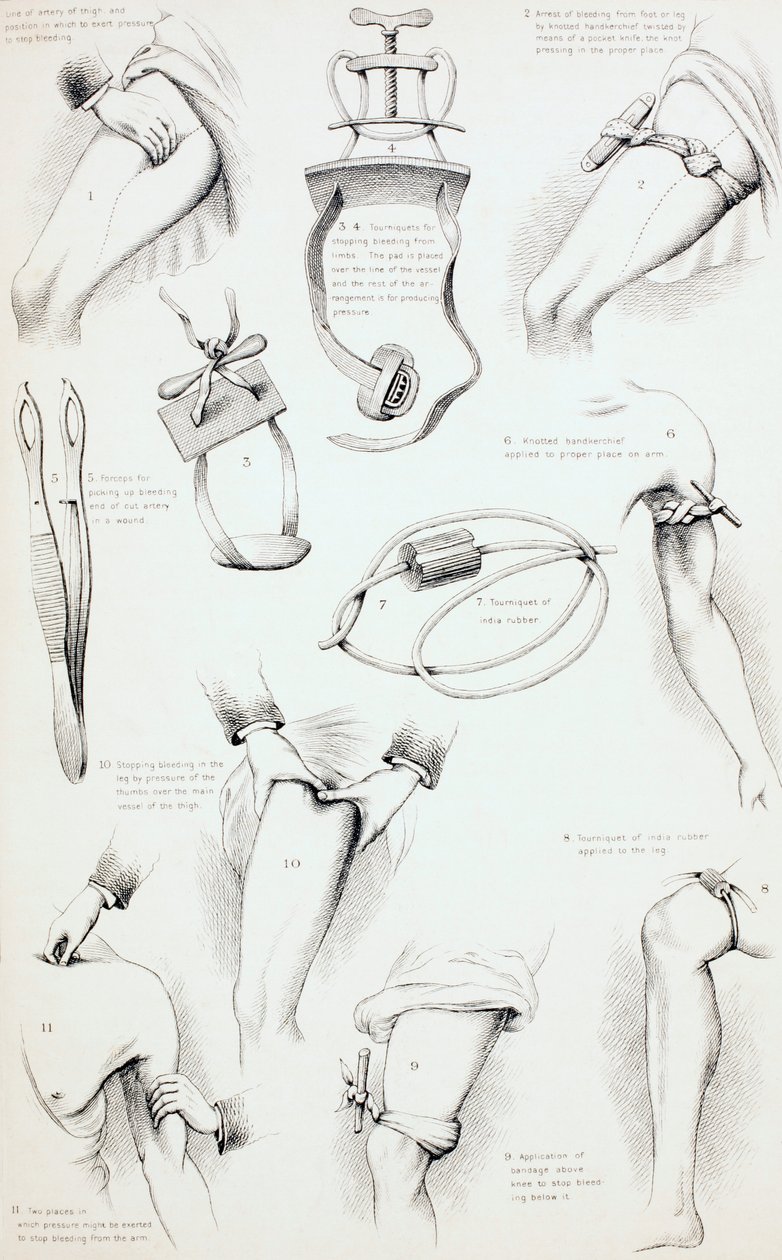 Methods of Arresting Bloeding, n. 1890 tekijältä English School