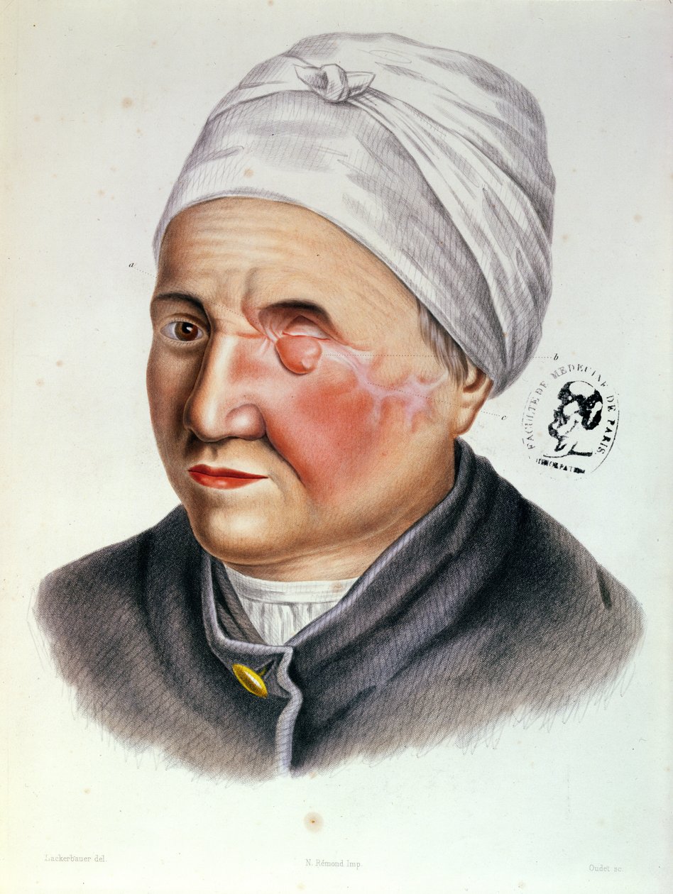 Kuvitus Traite de Chirurgie Plastiquesta, Antoine Jobert de Lamballe (1799-1867) Paris, 1849 tekijältä Lackerbauer