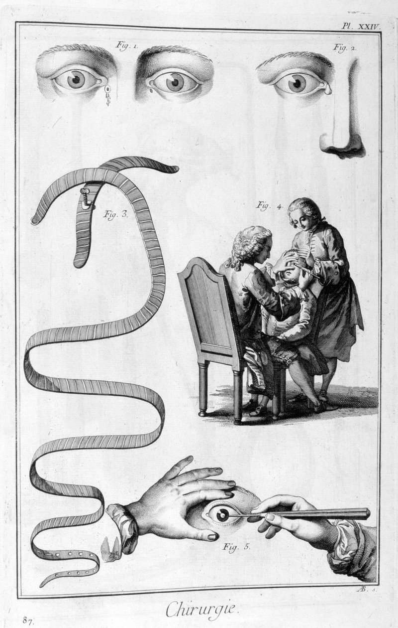 Silmäkirurgia, 1751-1777 tekijältä Unbekannt