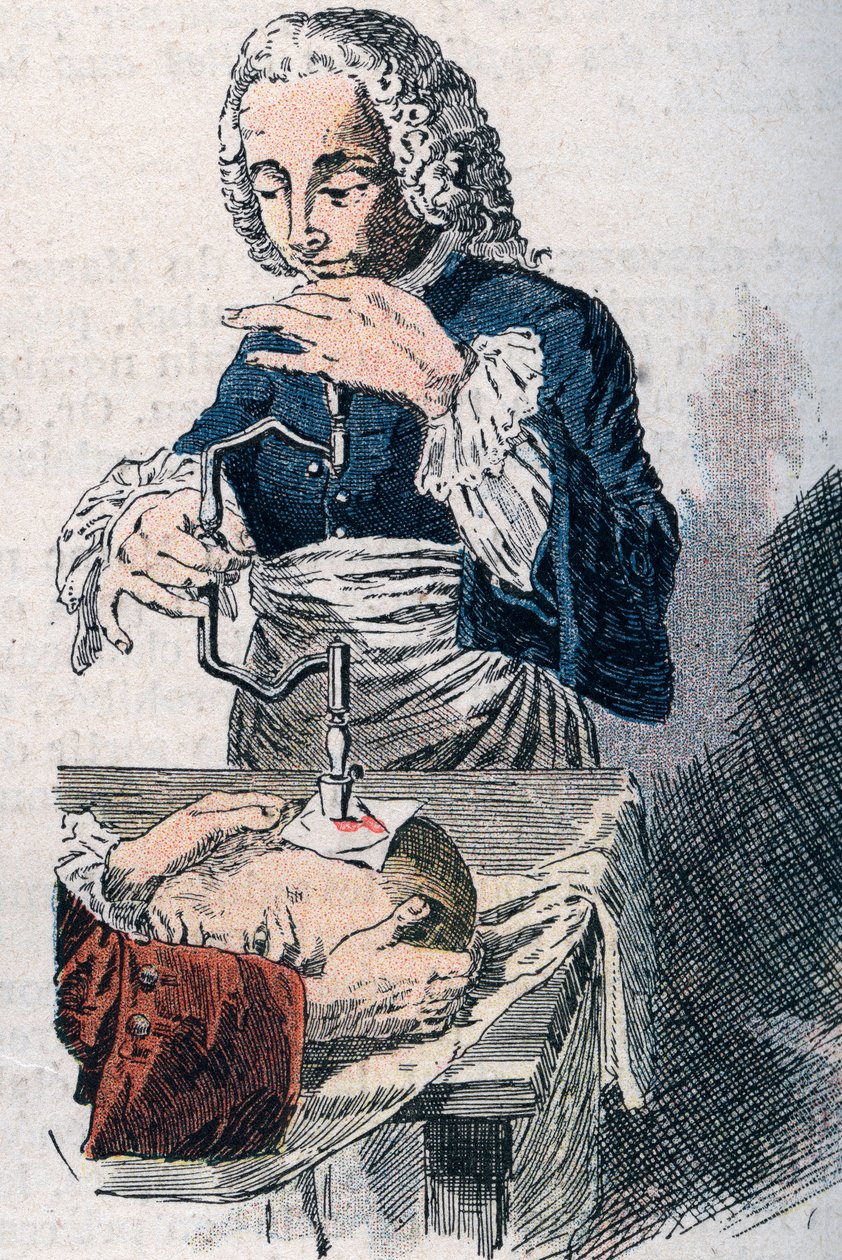 Trepanaatio. 1700-luvun printti. tekijältä Unknown artist