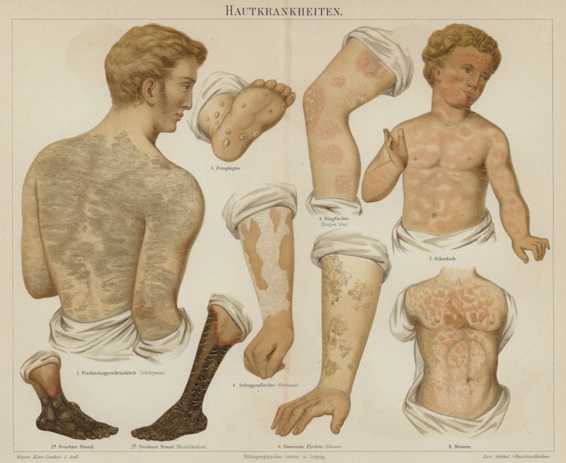Ihosairaudet (väri litho) tekijältä German School